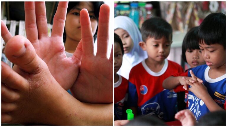 Peningkatan kes HFMD mendadak, pakar kesihatan kongsi tip mencegah dan merawat
