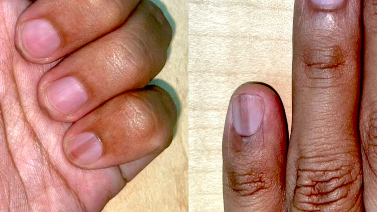 Melanonychia: Garis kehitaman pada kuku mungkin petanda penyakit serius