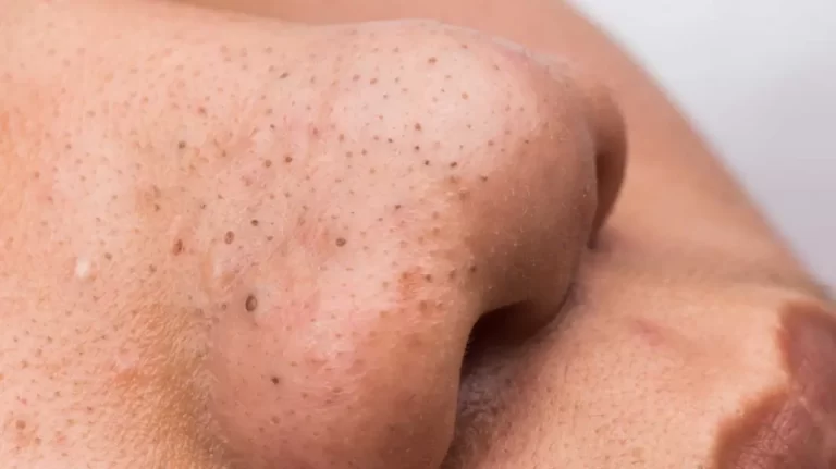 6 cara yang betul untuk menyingkirkan blackheads di muka
