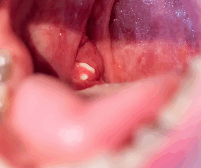 Nafas berbau? Batu tonsil mungkin penyebabnya